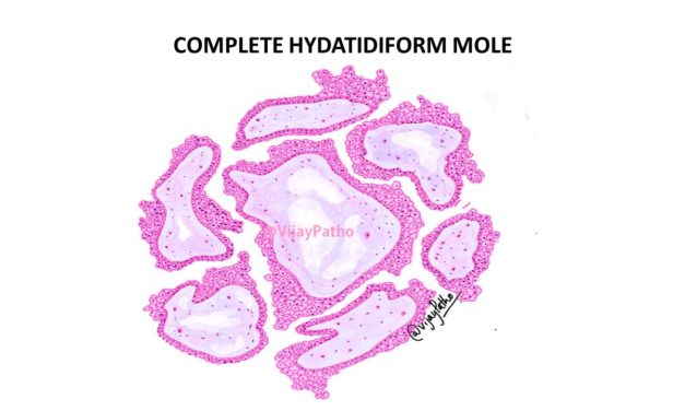 COMPLETE HYDATIDIFORM MOLE