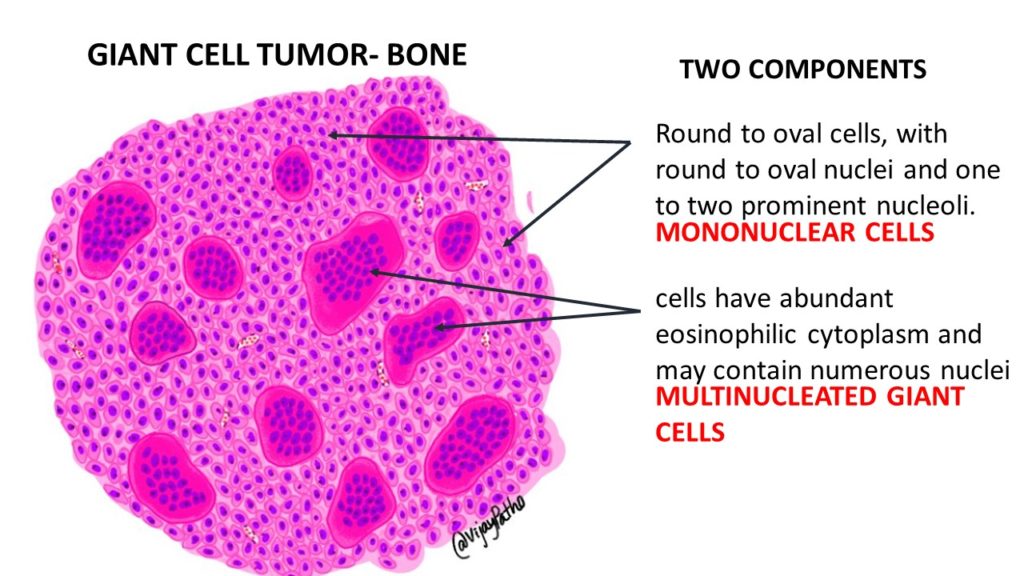 Giant Cell Tumor Bone Pathology Made Simple