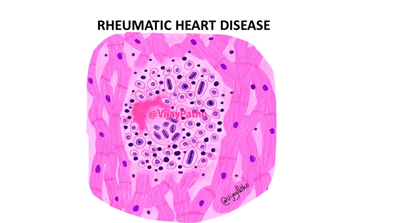 ACUTE RHEUMATIC FEVER Pathology Made Simple