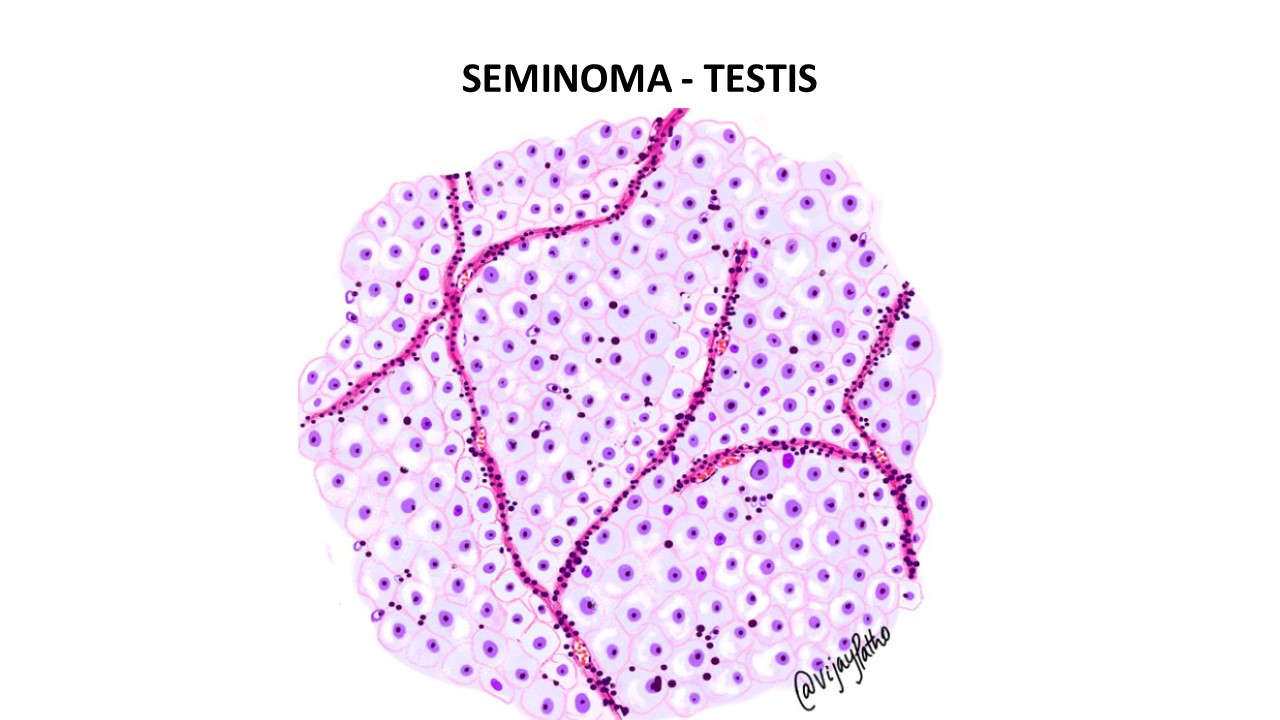 Seminoma Testis Pathology Made Simple