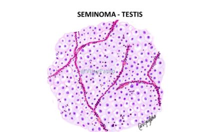 SEMINOMA- TESTIS