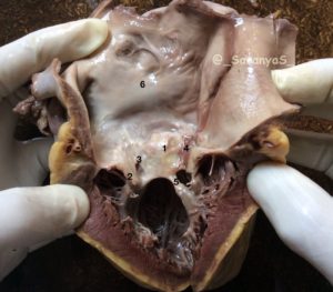 CHRONIC RHEUMATIC HEART DISEASE - Pathology Made Simple