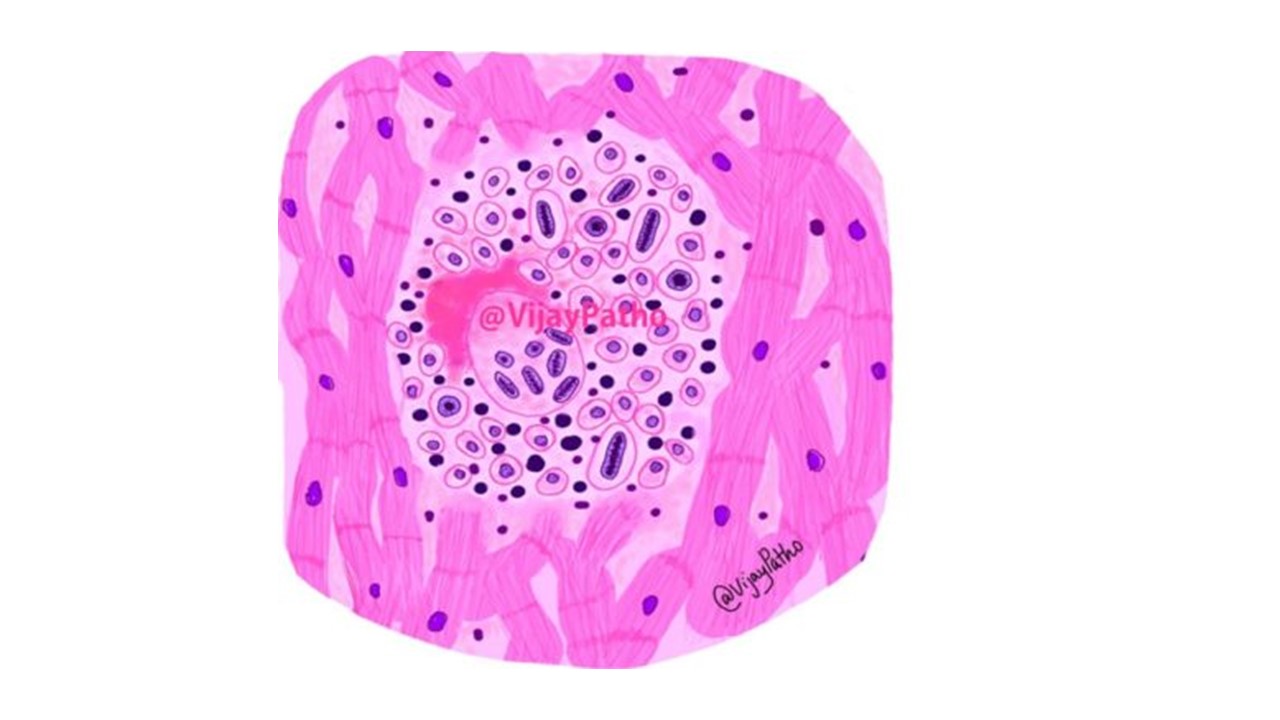 acute-rheumatic-fever-pathology-made-simple