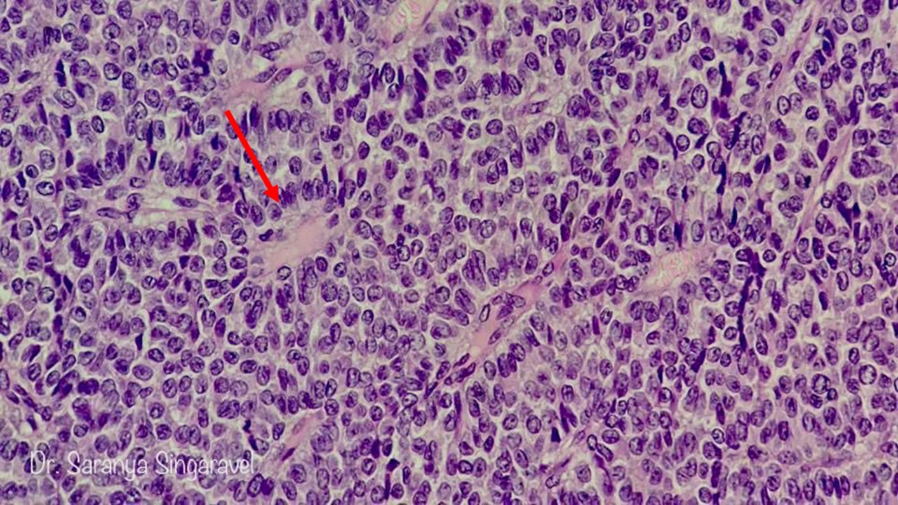 Granulosa Cell Tumor Ovary Pathology Made Simple