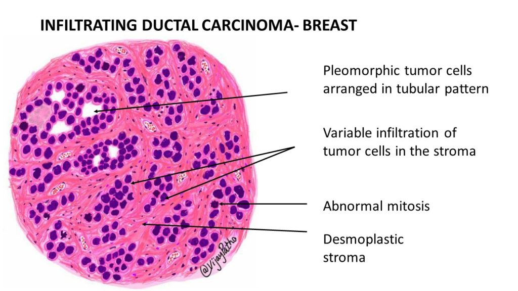 nfiltrating duct carcinoma- breast