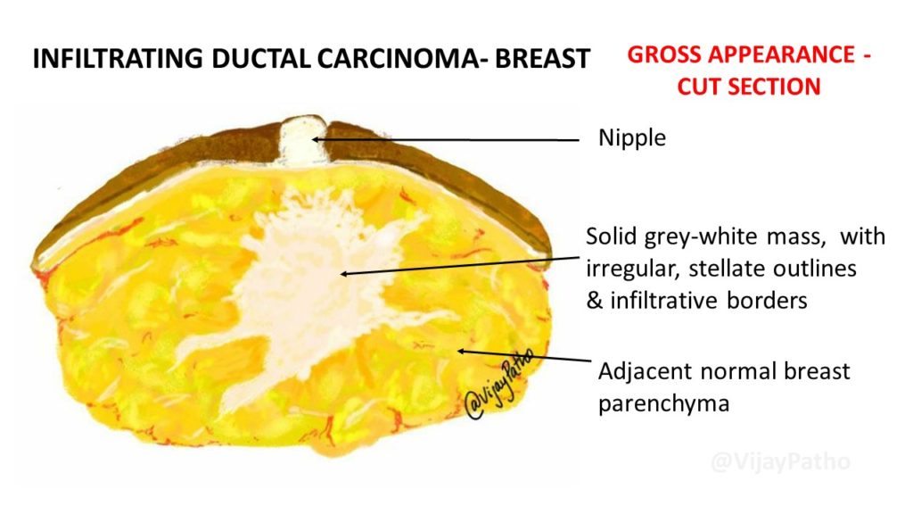 infiltrating duct carcinoma. gross