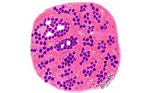 Pathology of Infiltrating duct carcinoma- Breast