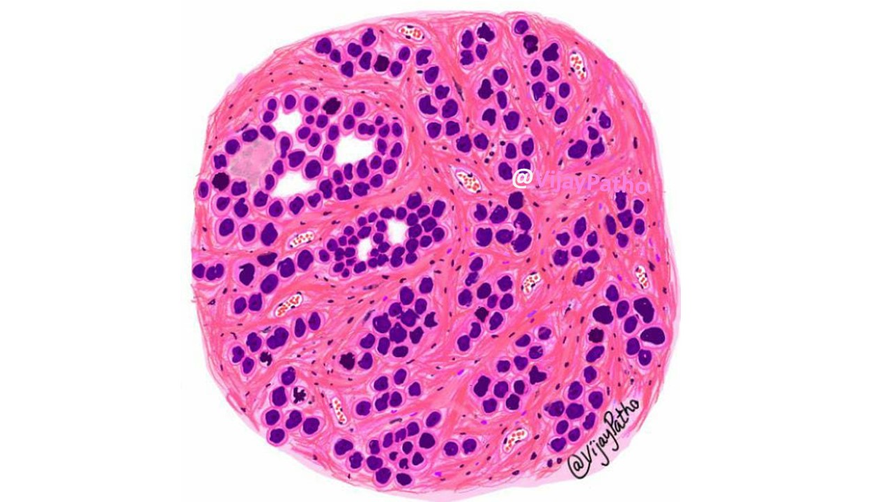 pathology-of-infiltrating-duct-carcinoma-breast-pathology-made-simple