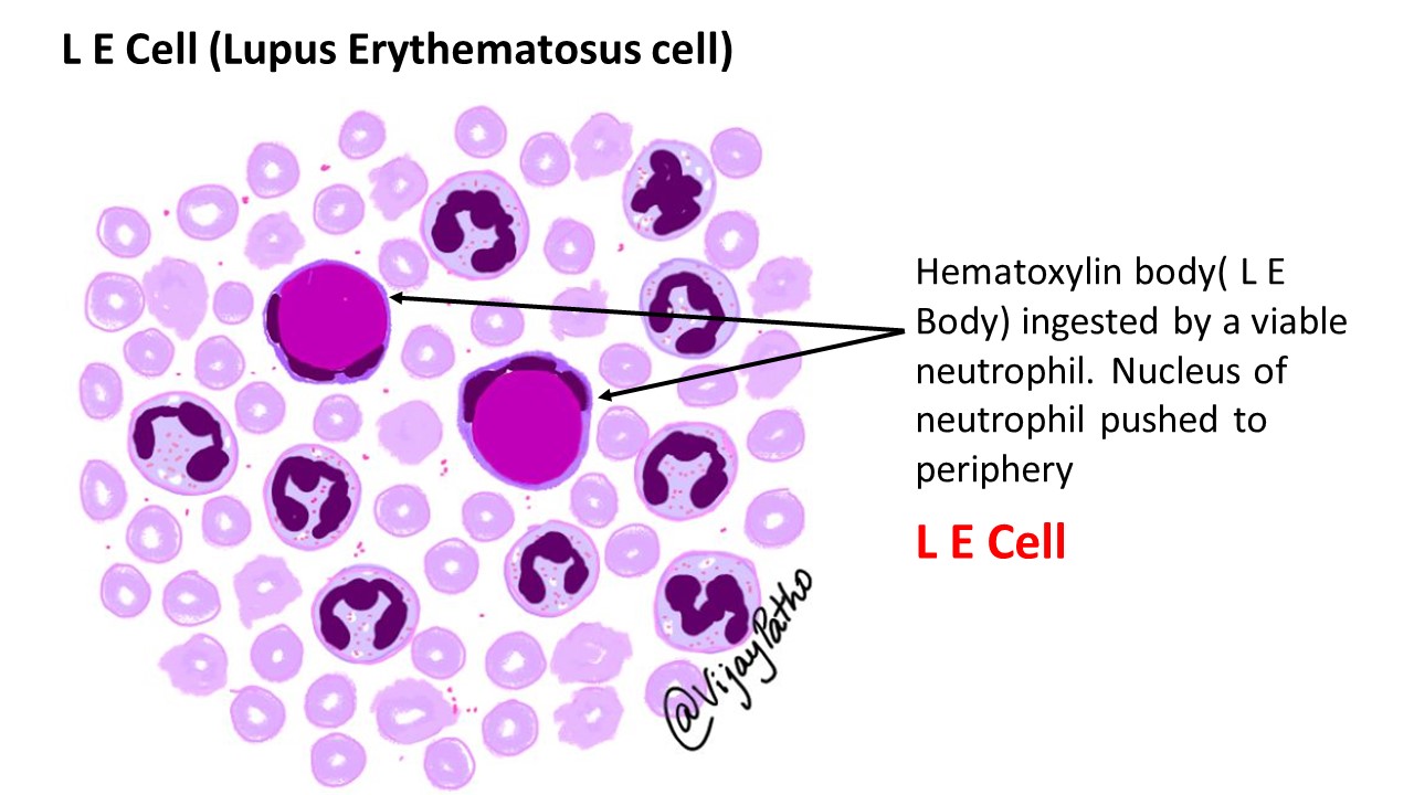 SYSTEMIC LUPUS ERYTHEMATOSUS: Lab Diagnosis & Morphology - Pathology ...