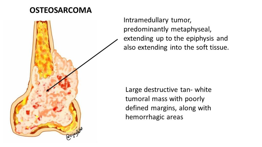 gross appearance of osteosarcoma