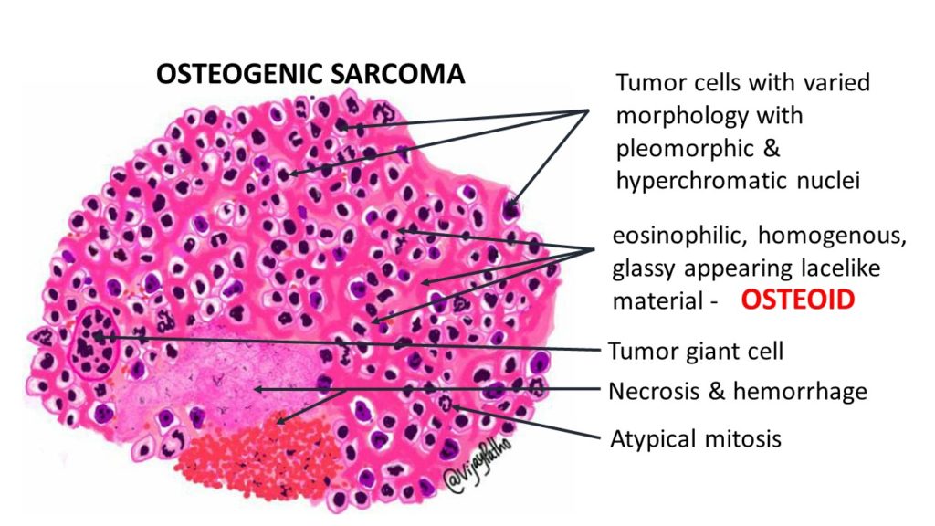 histopathology of osteosarcoma