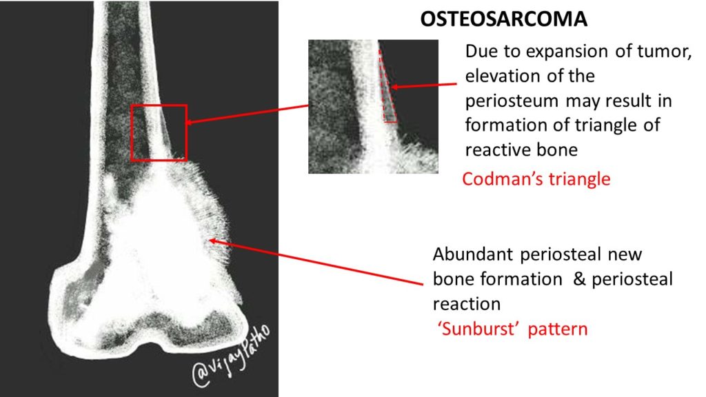radiology of osteosarcoma