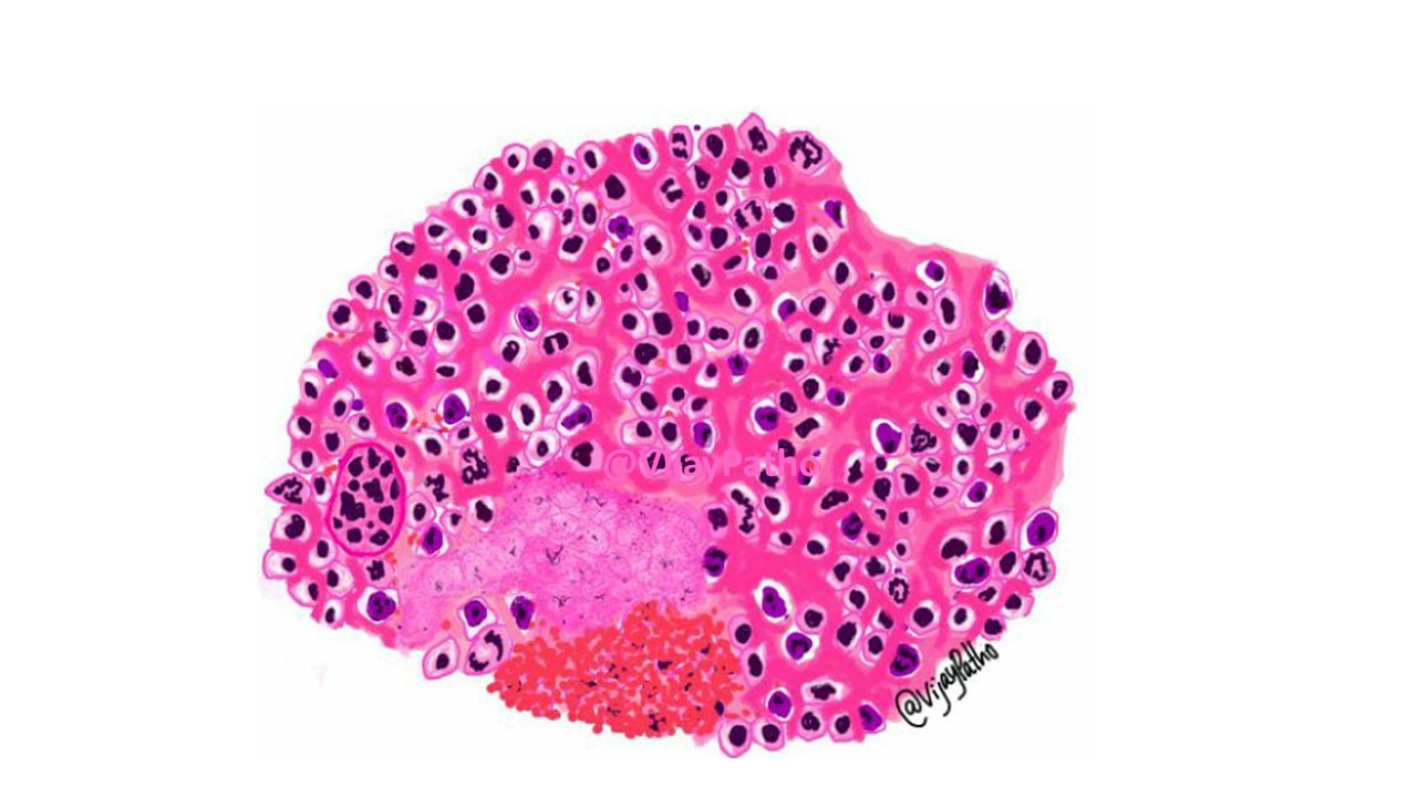 osteosarcoma-pathological-features-pathology-made-simple