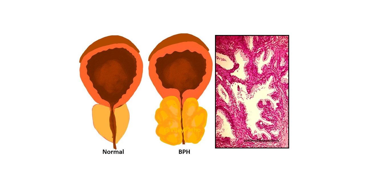 Benign prostatic hyperplasia(BPH) / Nodular hyperplasia of prostate