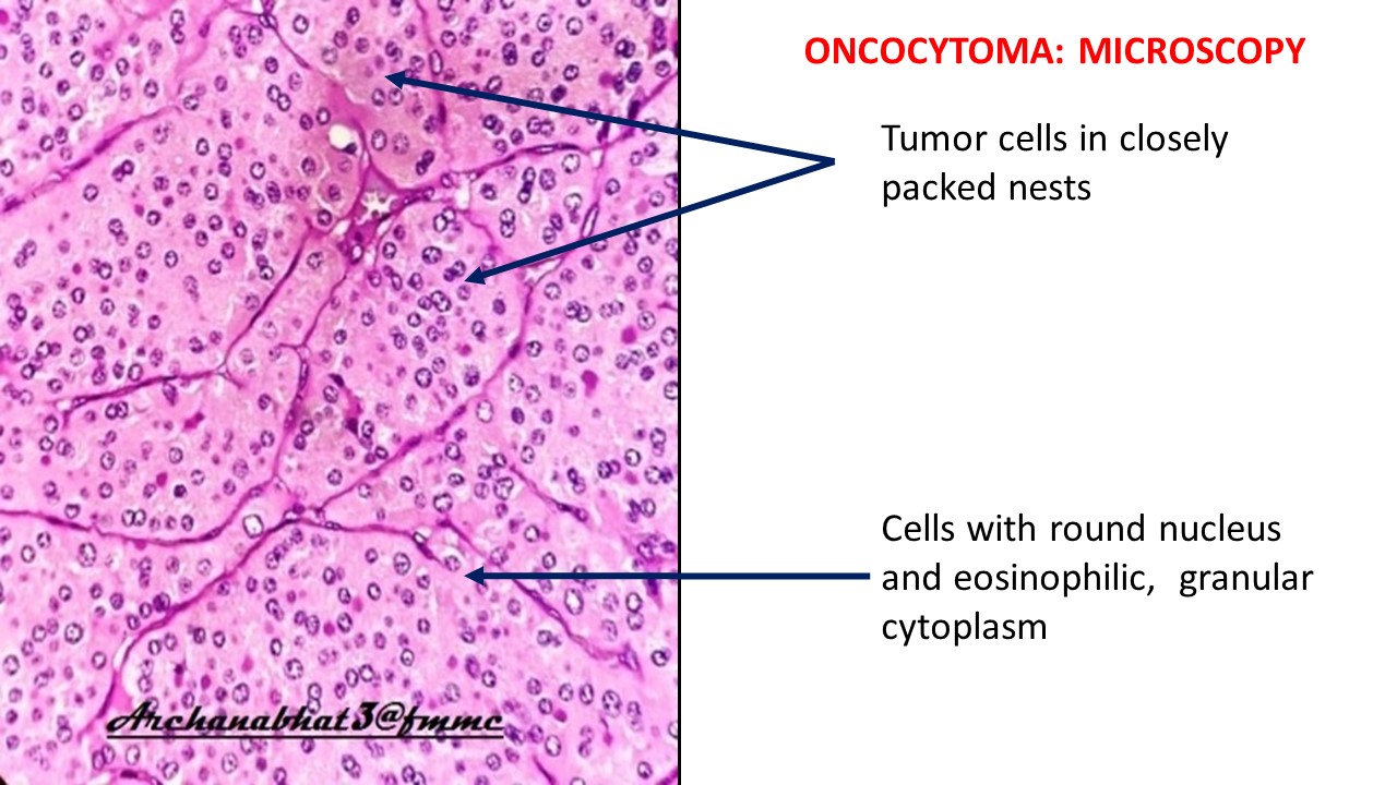 Pathology of Renal Oncocytoma | Pathology Made Simple