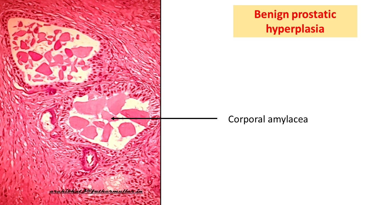 Benign Prostatic Hyperplasiabph Nodular Hyperplasia Of Prostate Pathology Made Simple 1954