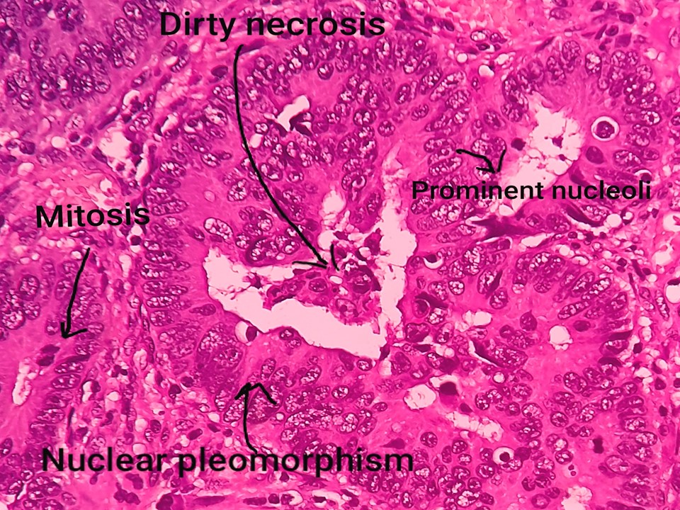 Adenocarcinoma Colon Histology