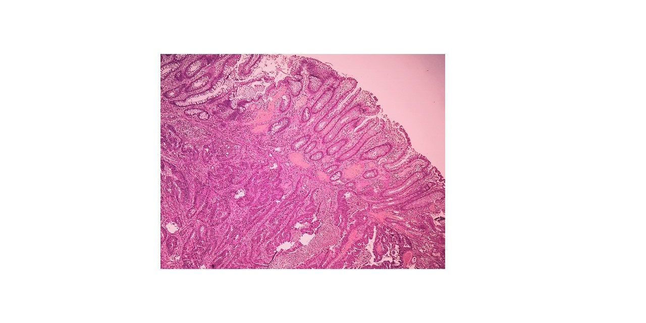 Pathology of Adenocarcinoma-Colon