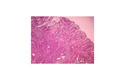 Pathology of Adenocarcinoma-Colon
