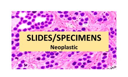 SLIDES/SPECIMENS: Neoplastic