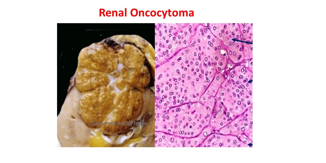Pathology of Renal Oncocytoma
