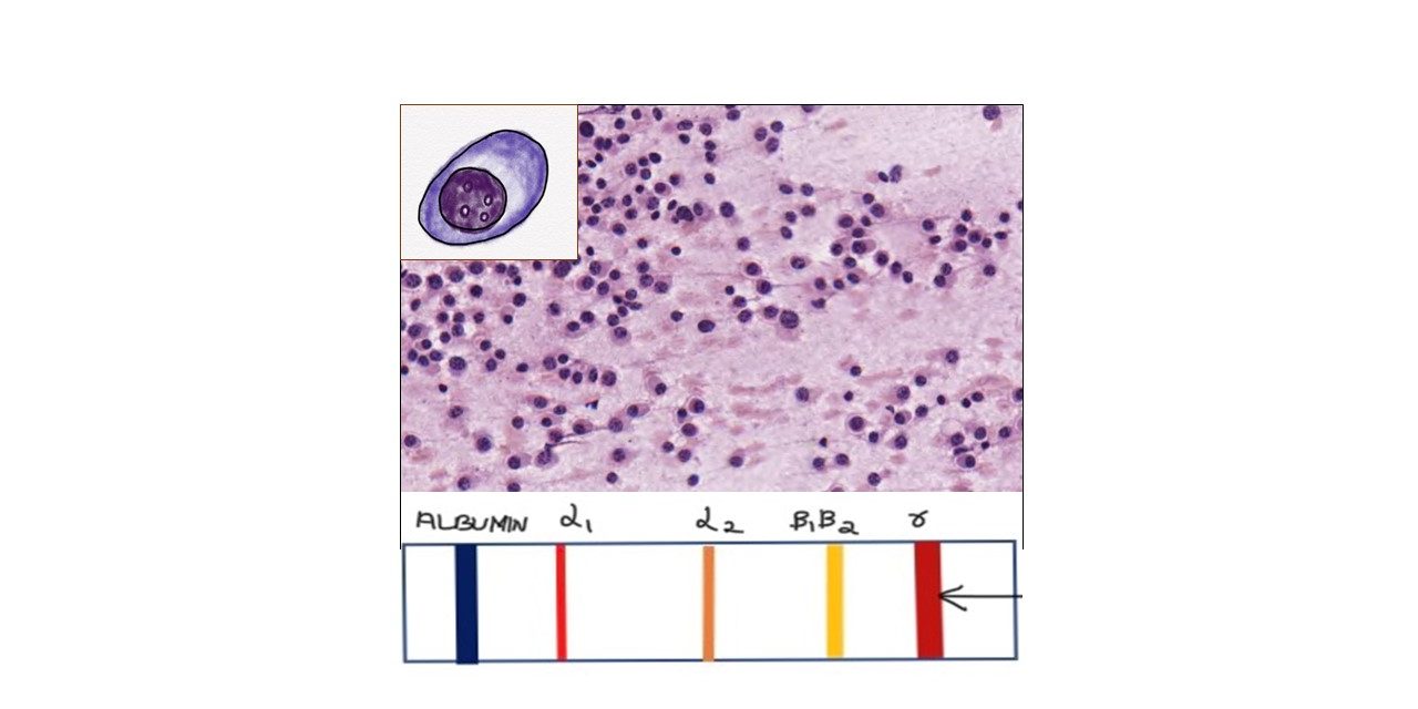 Pathology of Multiple Myeloma