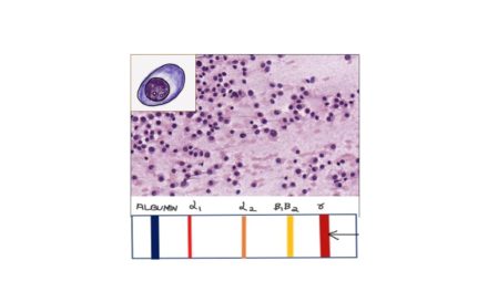 Pathology of Multiple Myeloma