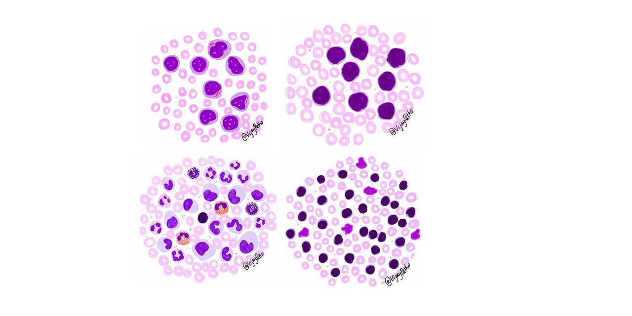 Peripheral smear findings in Leukemia –  Illustrated