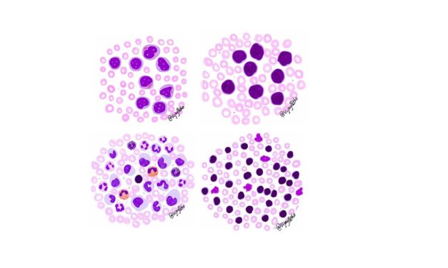 Peripheral smear findings in Leukemia –  Illustrated