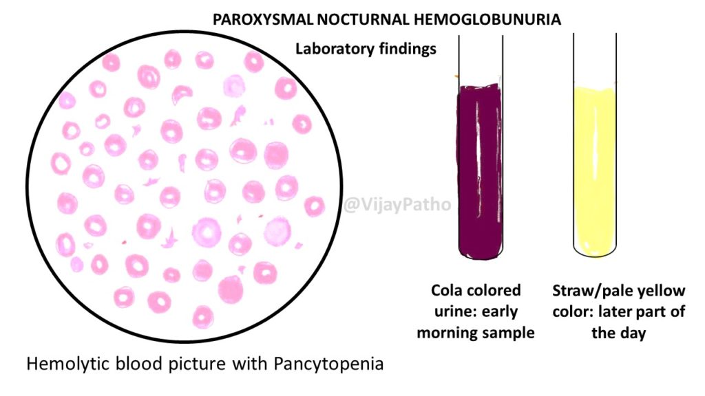 Paroxysmal Nocturnal Hemoglobinuria Urine