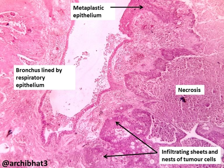 Squamous cell carcinoma of lung icd 10