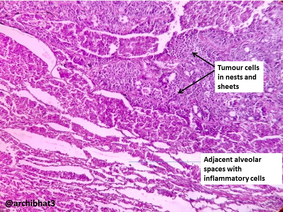 Pathology of Bronchogenic carcinoma /squamous cell carcinoma-lung ...