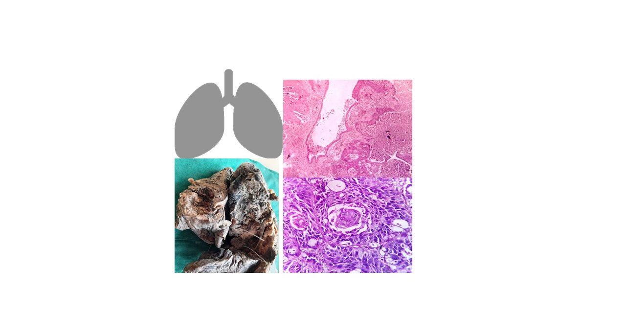 Pathology of Bronchogenic carcinoma /squamous cell carcinoma-lung