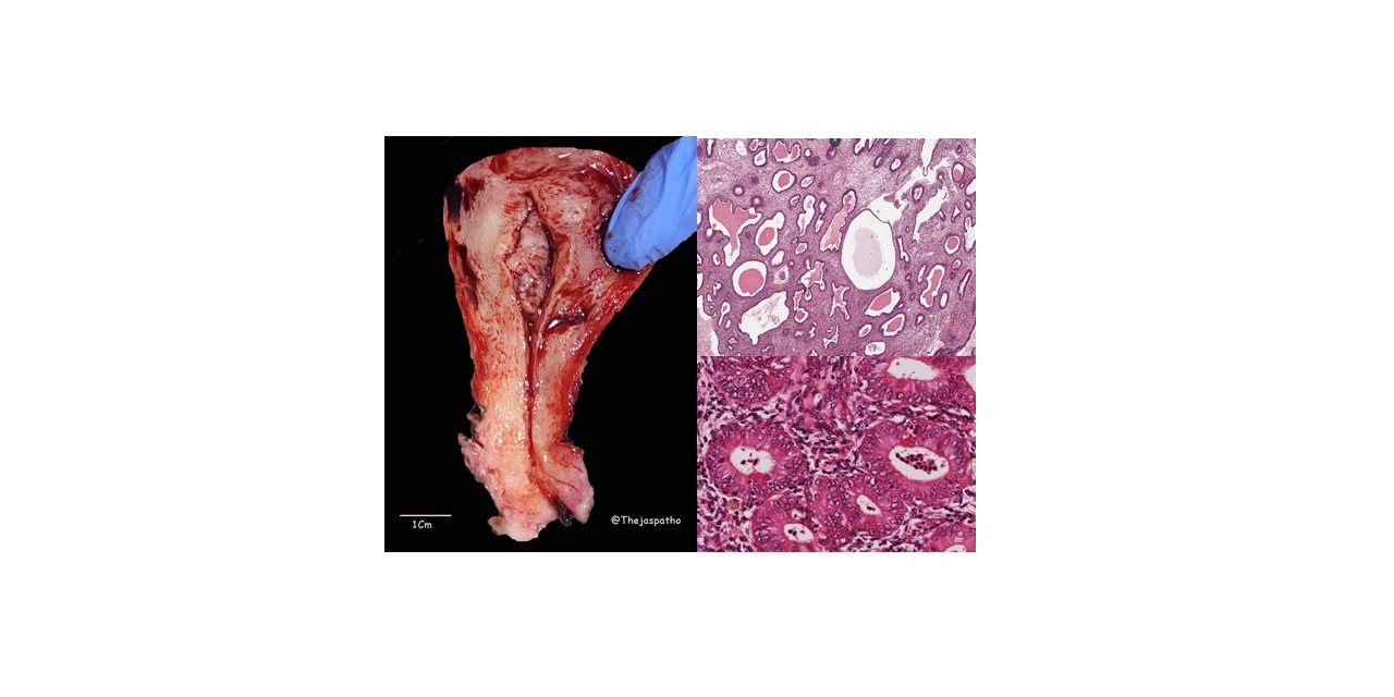 Pathology of Endometrial Hyperplasia