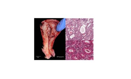 Pathology of Endometrial Hyperplasia