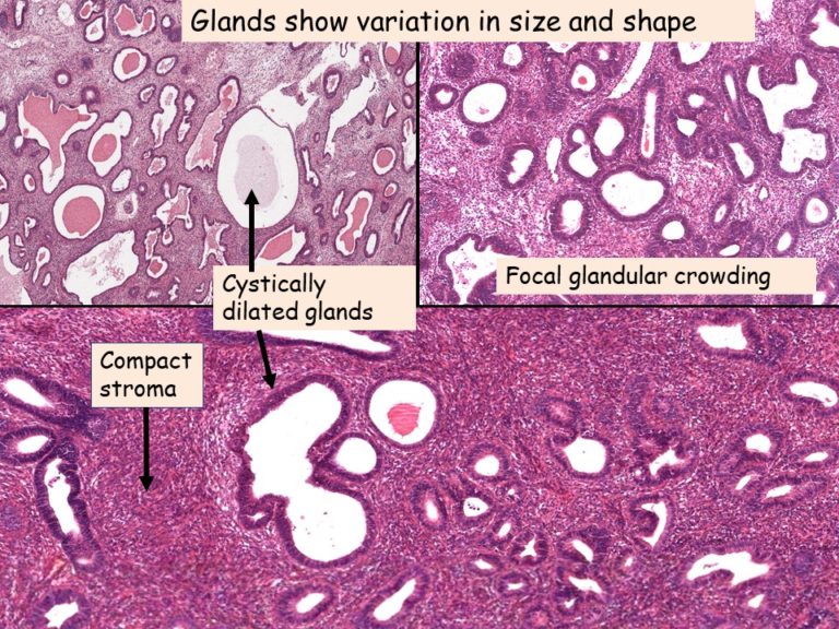 Pathology Of Endometrial Hyperplasia Pathology Made Simple