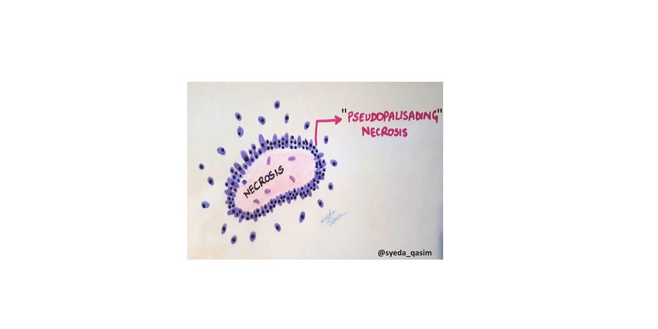 Pathology of Glioblastoma