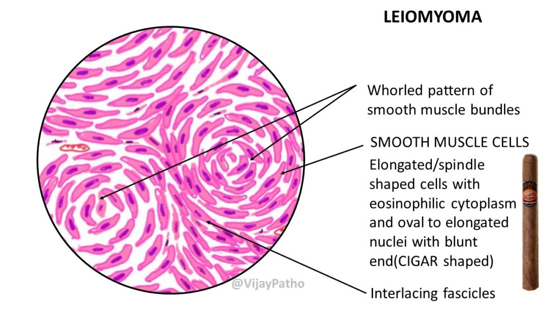 Pathology of Uterine Leiomyoma - Pathology Made Simple