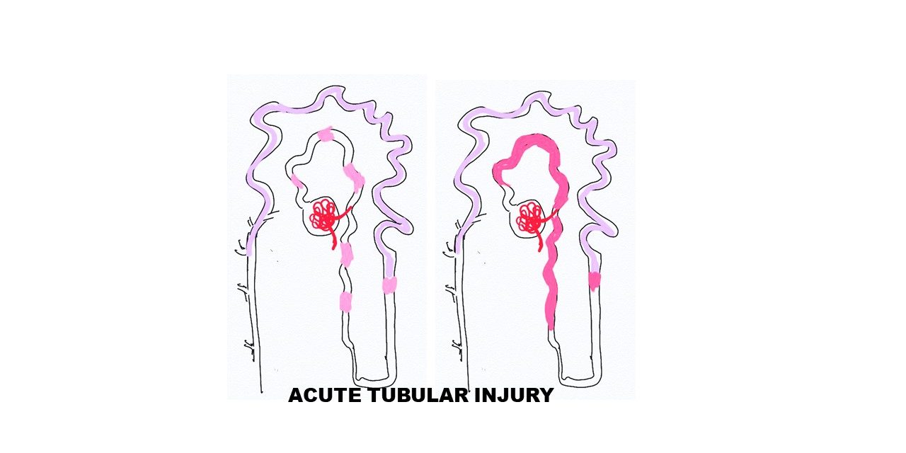 Pathology of Acute tubular injury/necrosis