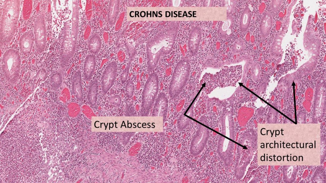 Pathology of Crohn's Disease - Pathology Made Simple