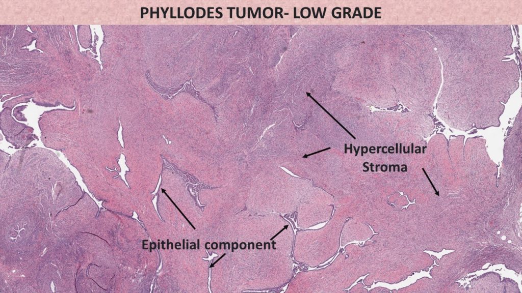 phyllodes tumor -benign