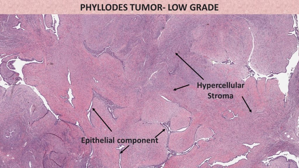 phyllodes-tumor-pathology-made-simple