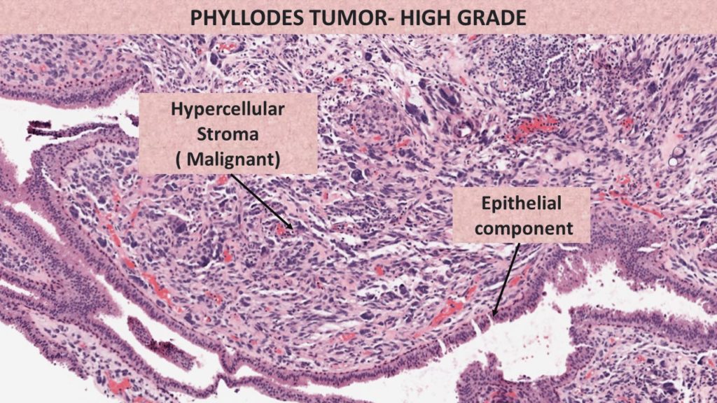 phyllodes tumor- malignant