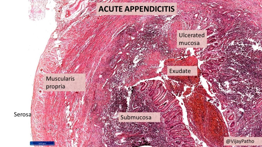 Appendicitis Histology