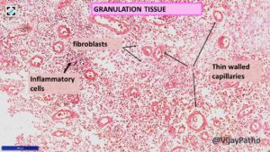 TISSUE REPAIR: By Connective tissue deposition. Angiogenesis & Tissue ...