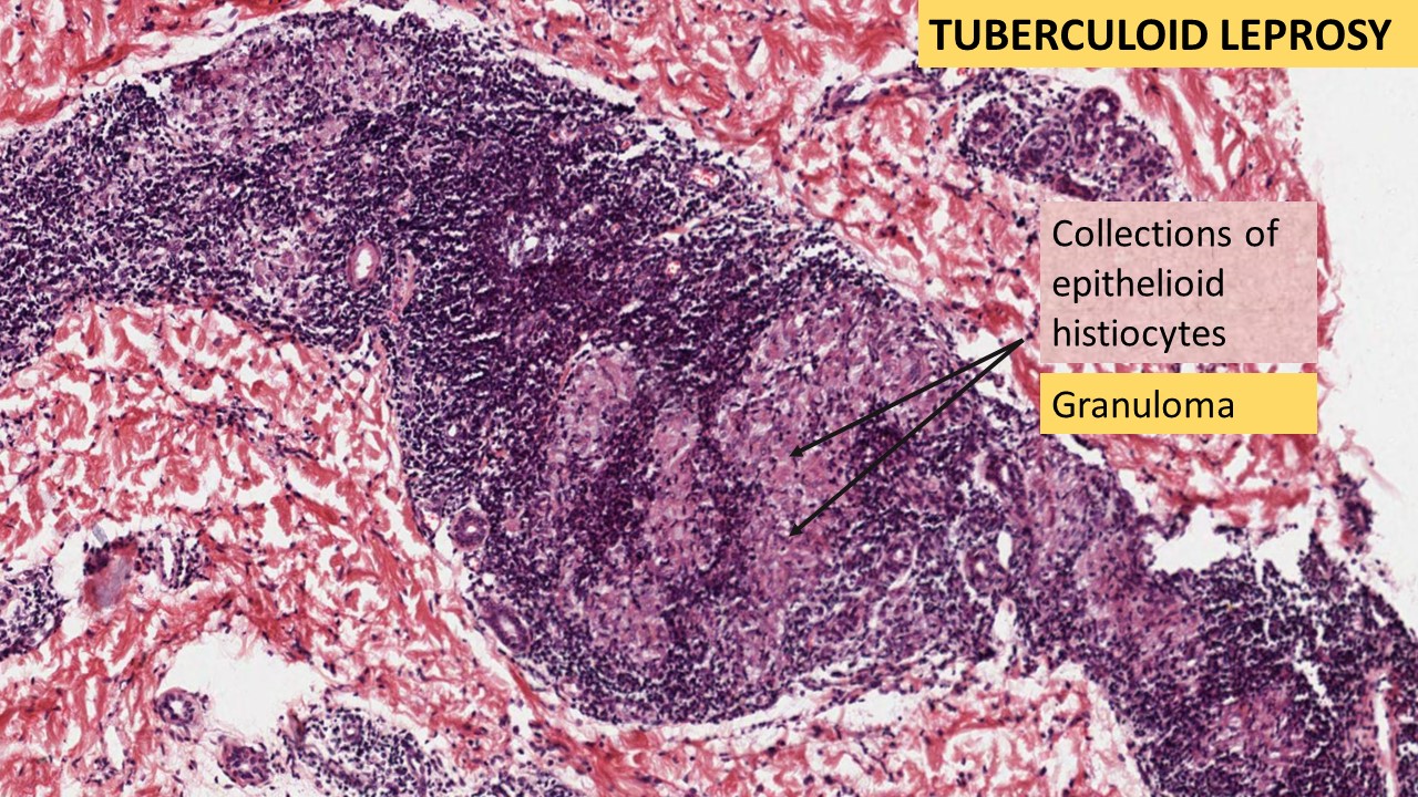 LEPROSY- Tuberculoid & Lepromatous | Pathology Made Simple