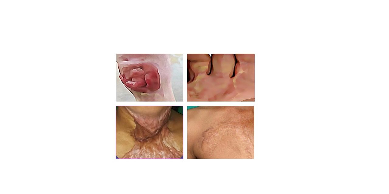 TISSUE REPAIR: Abnormalities/ Complications in wound  healing