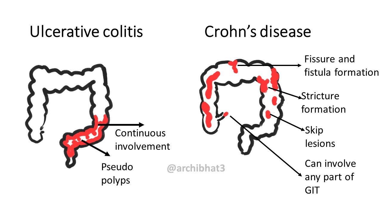 pathology-of-ulcerative-colitis-pathology-made-simple