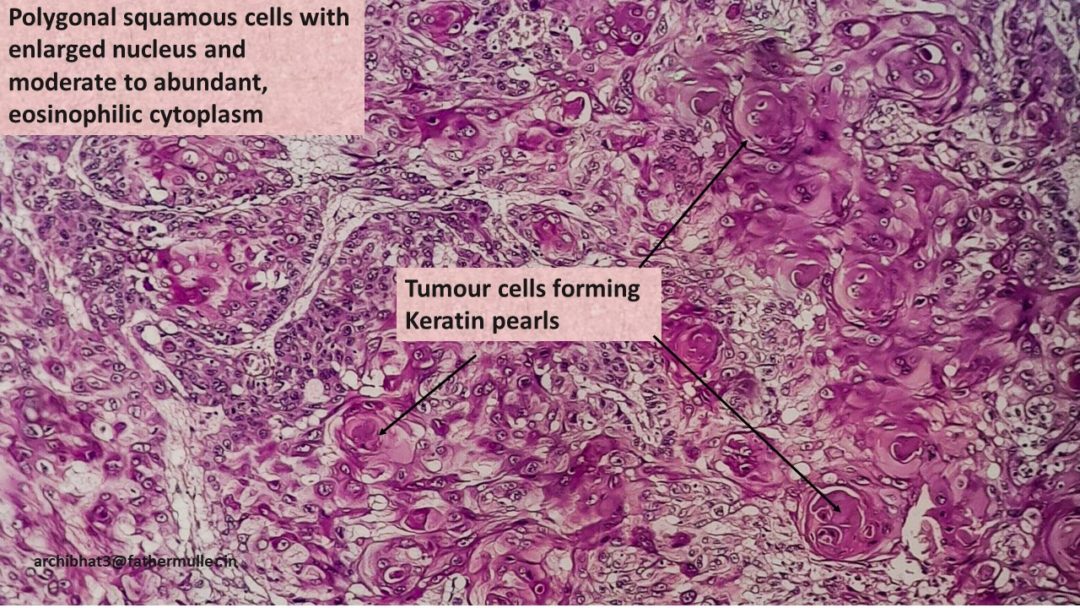 Pathology of Esophageal Squamous cell carcinoma | Pathology Made Simple