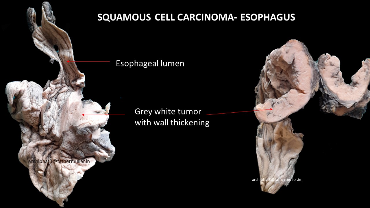 Pathology Of Esophageal Squamous Cell Carcinoma Pathology Made Simple